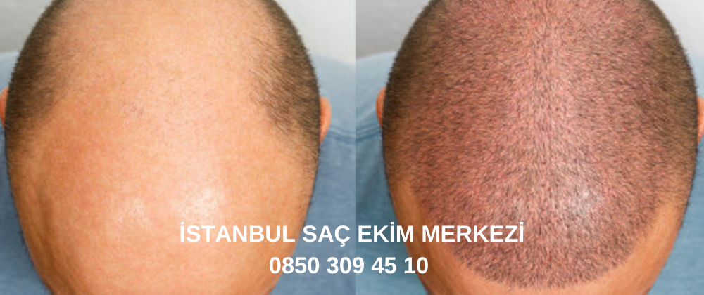 Saç Ekimi Sonrası Bakım